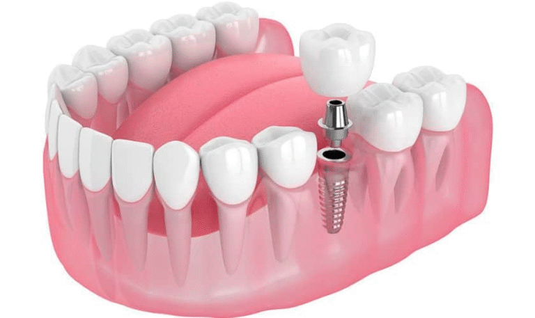 Dental Implants: The Lifelong Solution to Missing Teeth